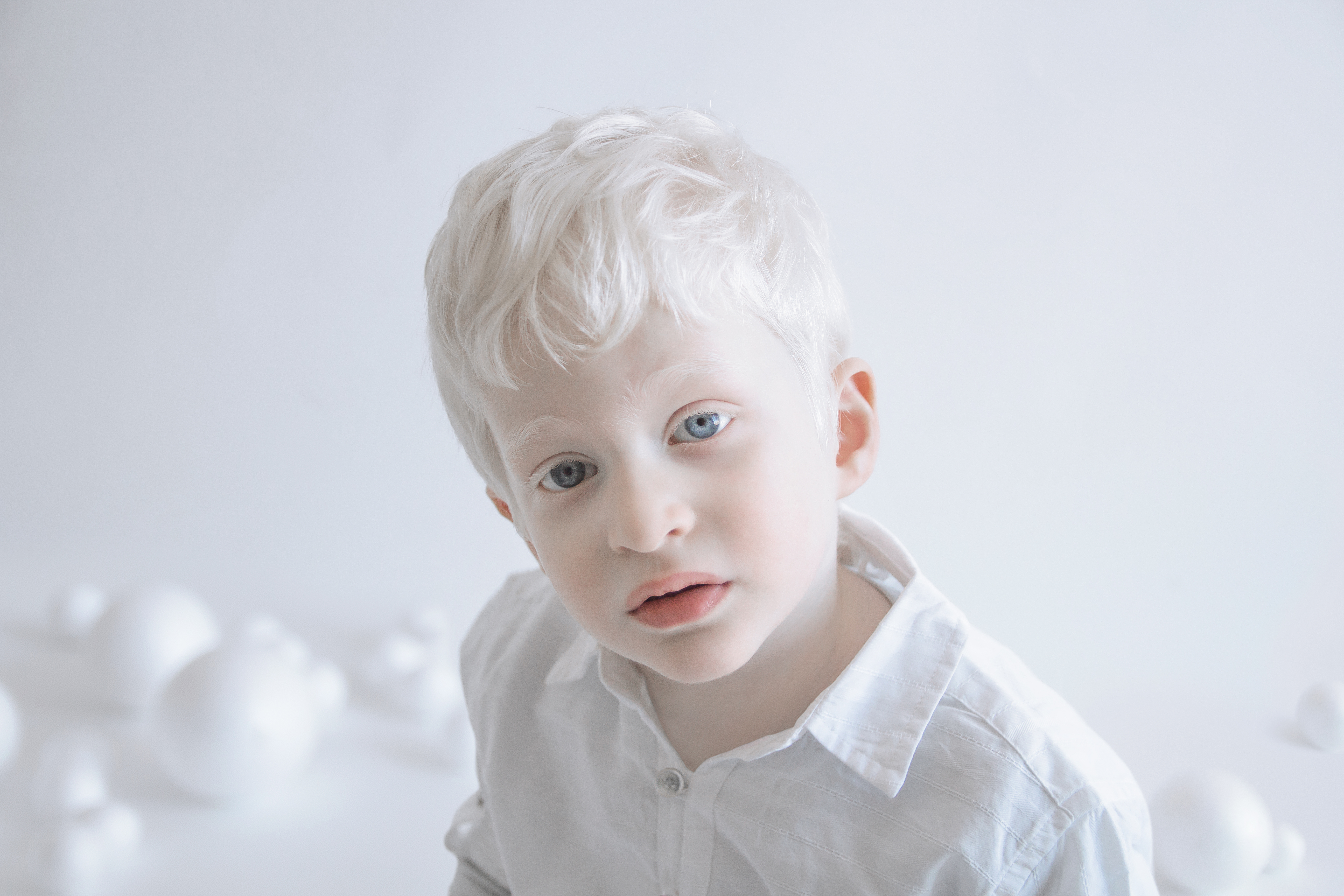 Как люди рождаются альбиносами. Дэн Баккедаль альбинос. Альбинизм 1в.